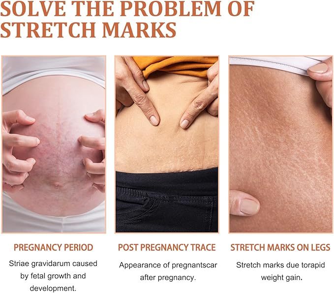 EELHOE Stretch Mark Repair Cream 45g