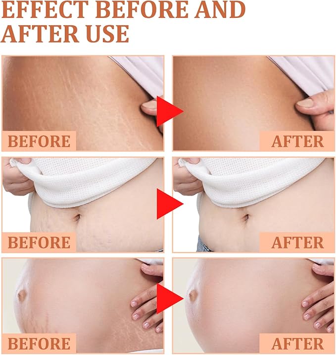 EELHOE Stretch Mark Repair Cream 45g